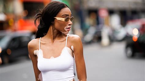 vitiligo nude|Model Winnie Harlow Proudly Shows Her Vitiligo in a New Nude。